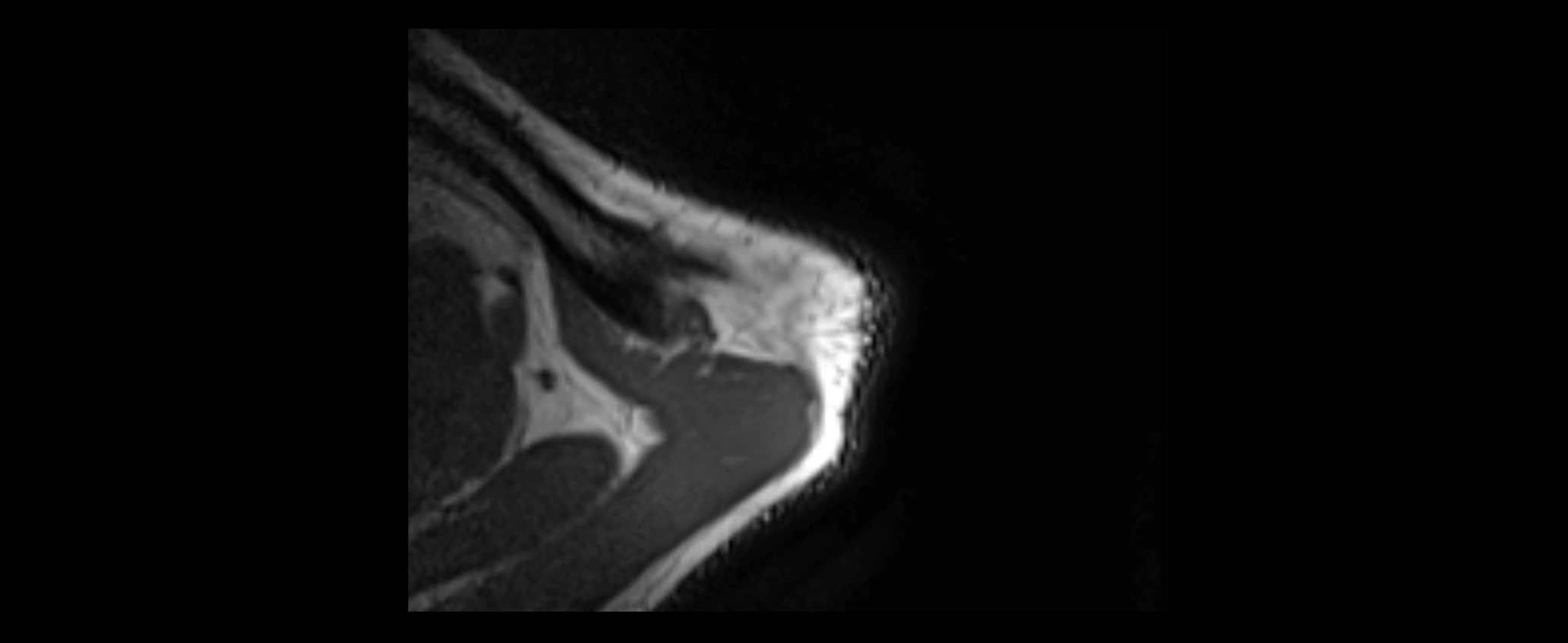 shoulder ligaments axial 3d 3t mri image-img-00005-00011.webp